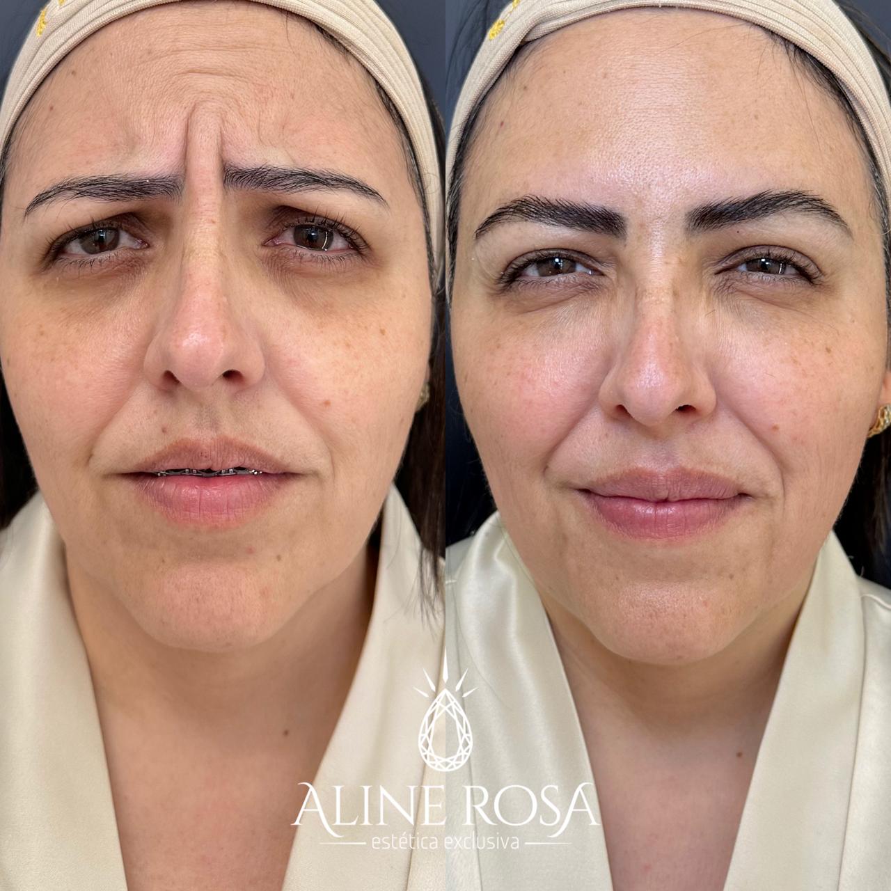 Botox Feminino